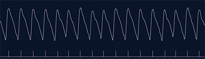 Masimo - High resolution view of the pleth waveform