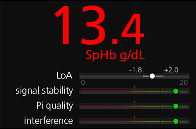 Masimo - Rad-67 - Signal quality indicators