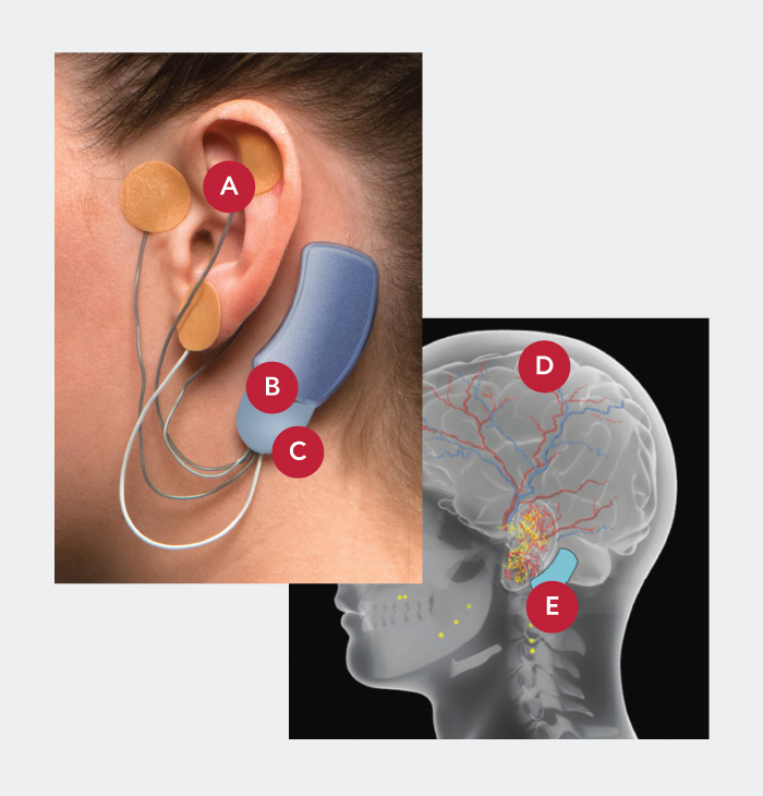 Masimo - Bridge application on ear with image call outs and brain illustration with call outs