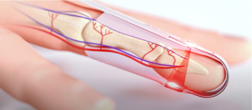 Illustration showing light from pulse oximetry sensor shining through the finger.